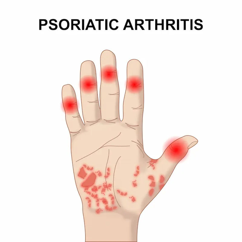 Psoriatic Arthritis Overview of Symptoms and Treatment